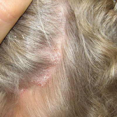 Ringworm: Treatment, Pictures, Causes, and Symptoms